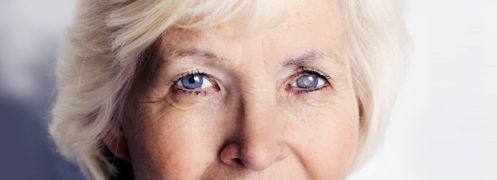 Cataract Surgery in Kent